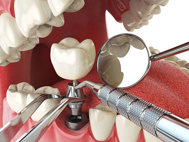 Best Broken or Chipped Tooth Repair in River Hills, WI